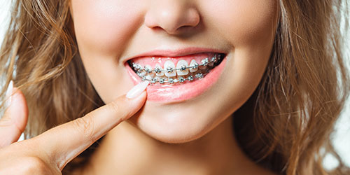 diastema-brackets-clinica-soria-blog