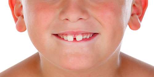 diastema-nino-clinica-soria-blog