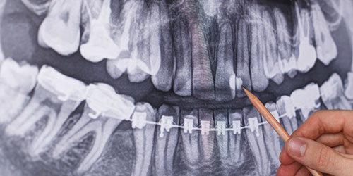 radiografia-carie-blog-clinica-sorias