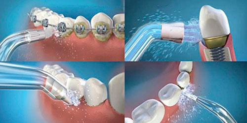 boquillas-irrigidaro-dental-blog-clinica-soria