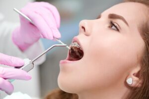 descalcificación dental - clínica dental sorias