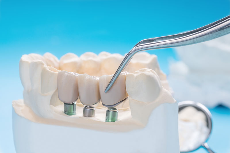 implante-cirugia-maxilofacial-blog-clinica-soria