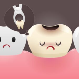Clínica Dental Sorias - beneficios de la colocación de implantes - Blog - Extraer diente con caries