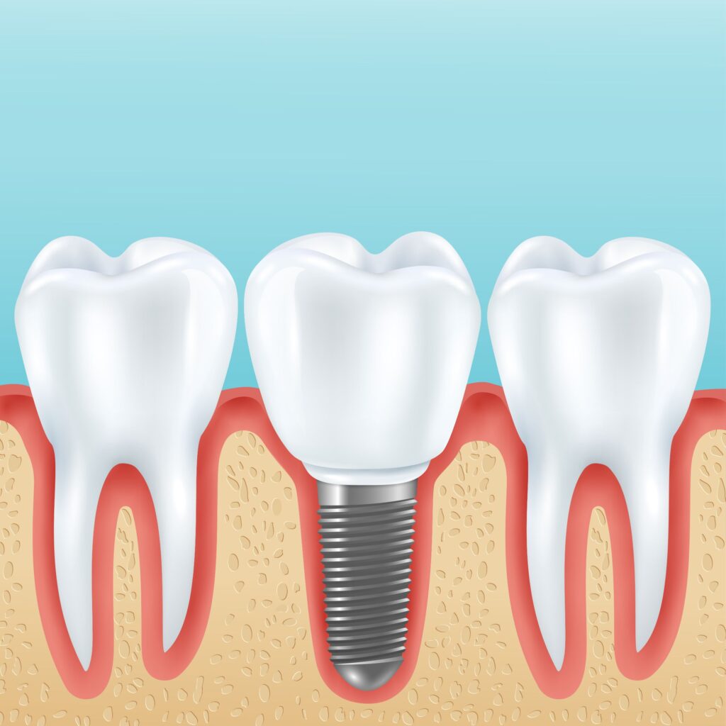 Clínica Dental Sorias - Blog - ¿Qué es un implante dental y por qué es tan popular? - Implante