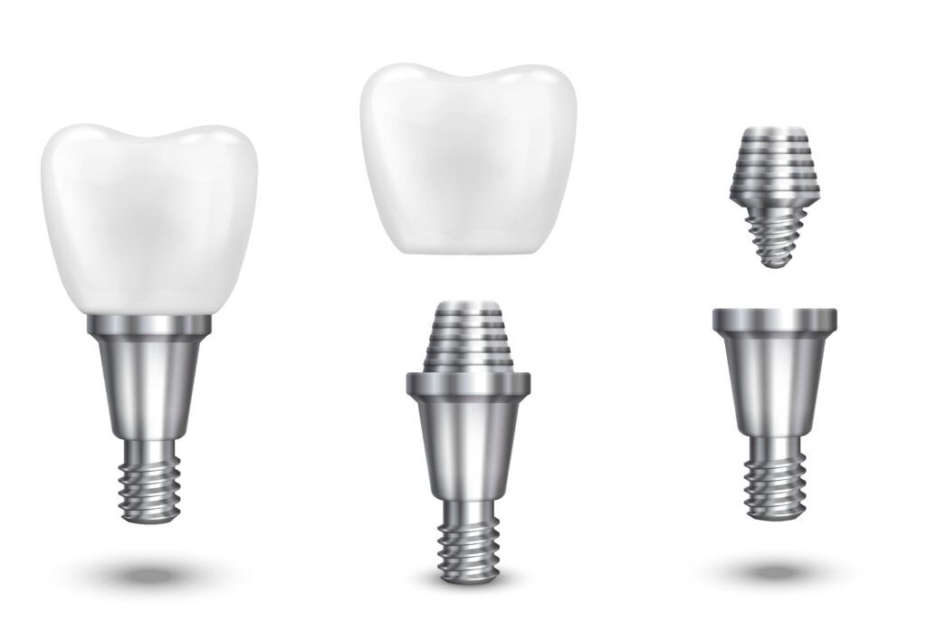 Clínica Dental Sorias - Blog - ¿Qué es un implante dental y por qué es tan popular? - Proceso implante