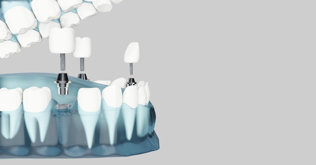 Clínica Dental Sorias - Blog - ¿Qué es un implante dental y por qué es tan popular? - Doble implante