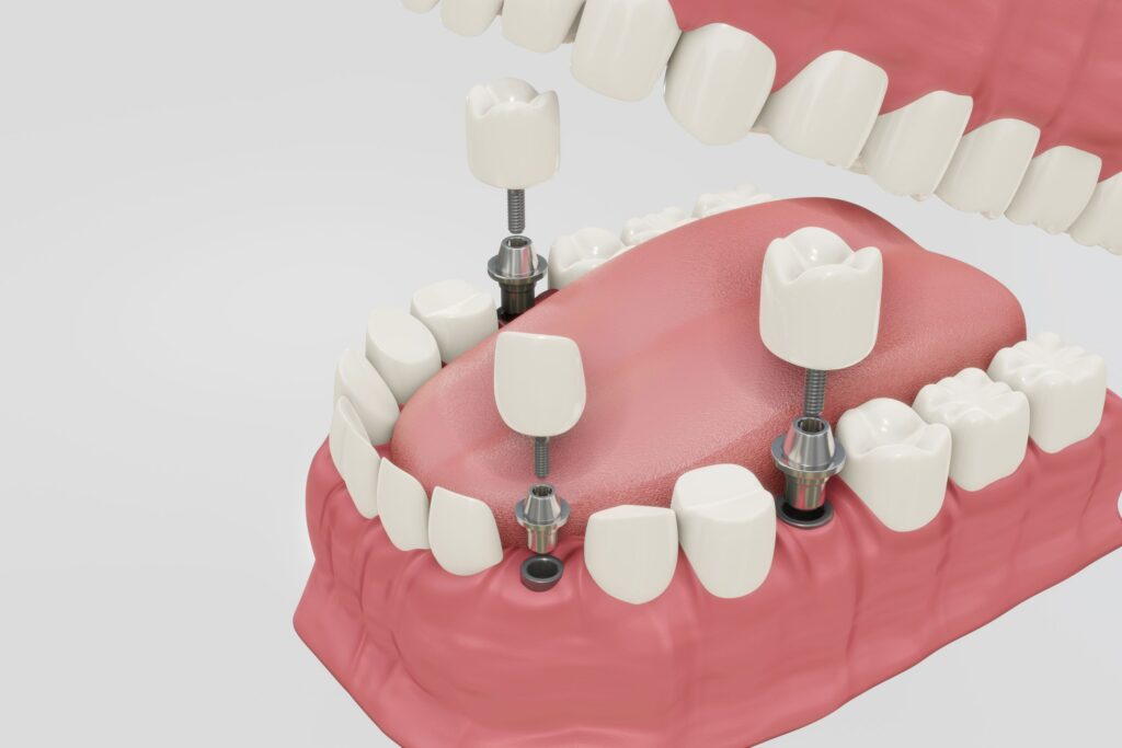 Clínica Dental Sorias - Blog - ¿Qué es un implante dental y por qué es tan popular? - Triple implante
