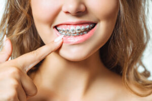 brackets-blog-clinica-soria