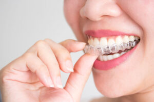 ortodoncia-invisible-blog-clinica-soria