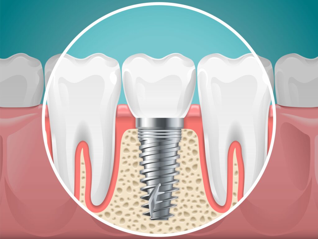 Clínica Dental Sorias - Blog - El reto de la apertura de la línea de incisión - Representación Implante