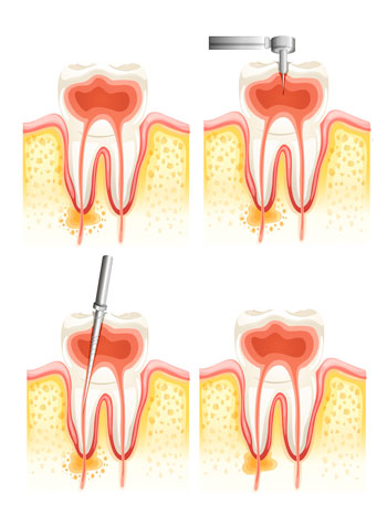 tratamiento-endodoncia-blog-clinica-soria