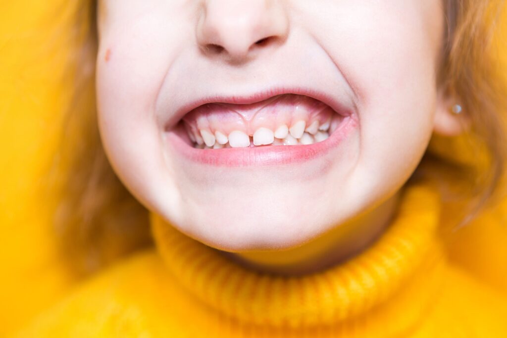 Clínica Dental Sorias - Blog - Qué podemos hacer para mantener nuestras encías sanas - Encías niña