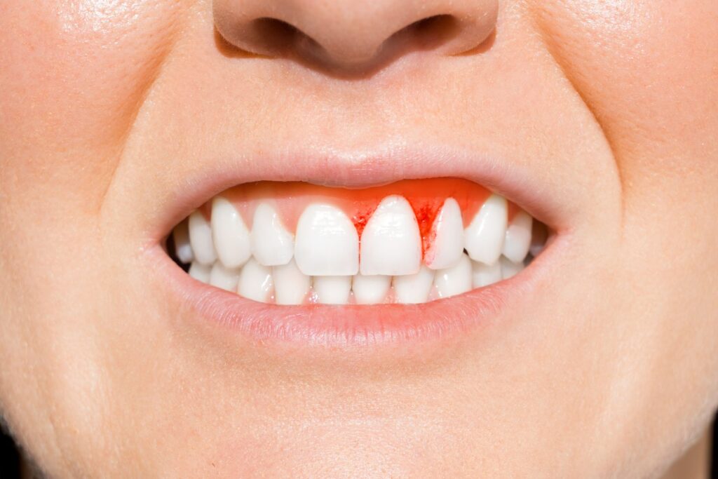 porque sangran las encias - clínica dental sorias