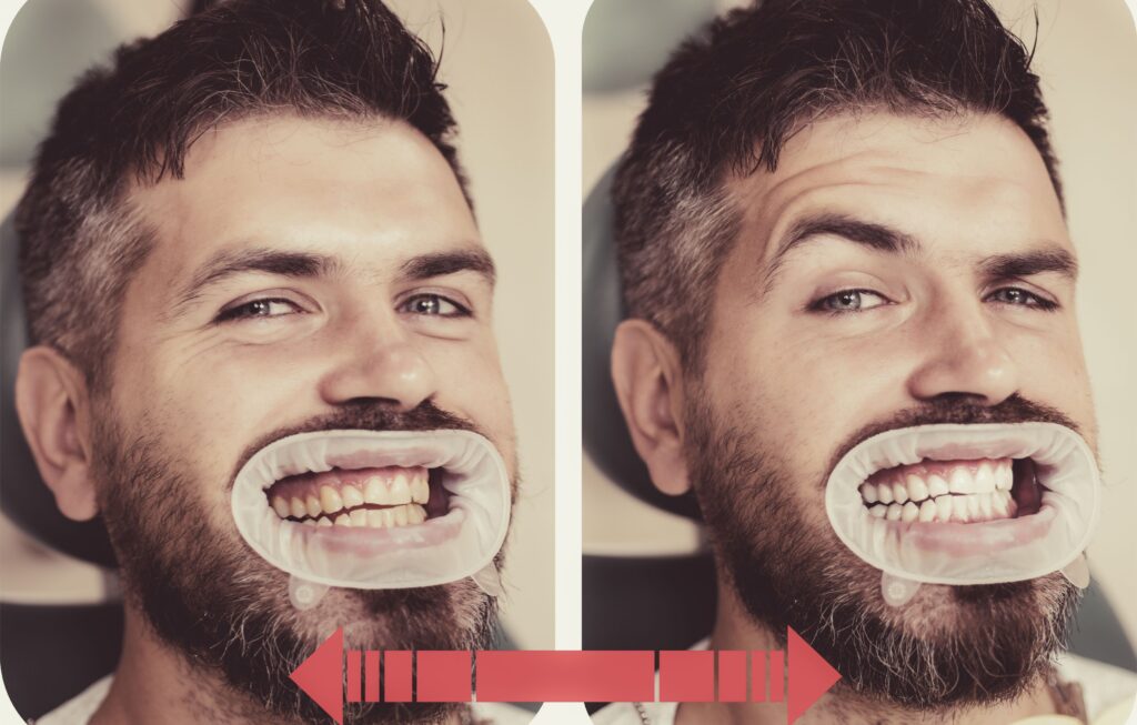 Clínica Dental Sorias - Blog - ¿Es el café el culpable de las marcas amarillas en tus dientes? - Blanqueamiento dental manchas café