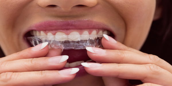 Chica colocandos la funda dental invisalign