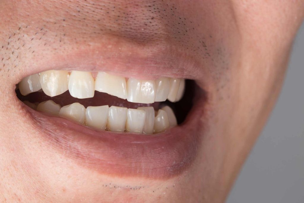 Boca de hombre adulto con una rotura dental