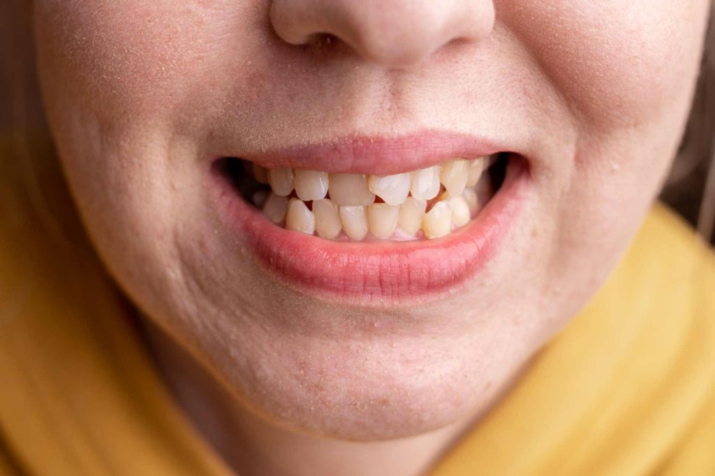 Primer plano de boca femenina con dentadura movida por pérdida de dientes